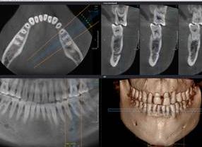 Дентальная компьютерная томография зубов