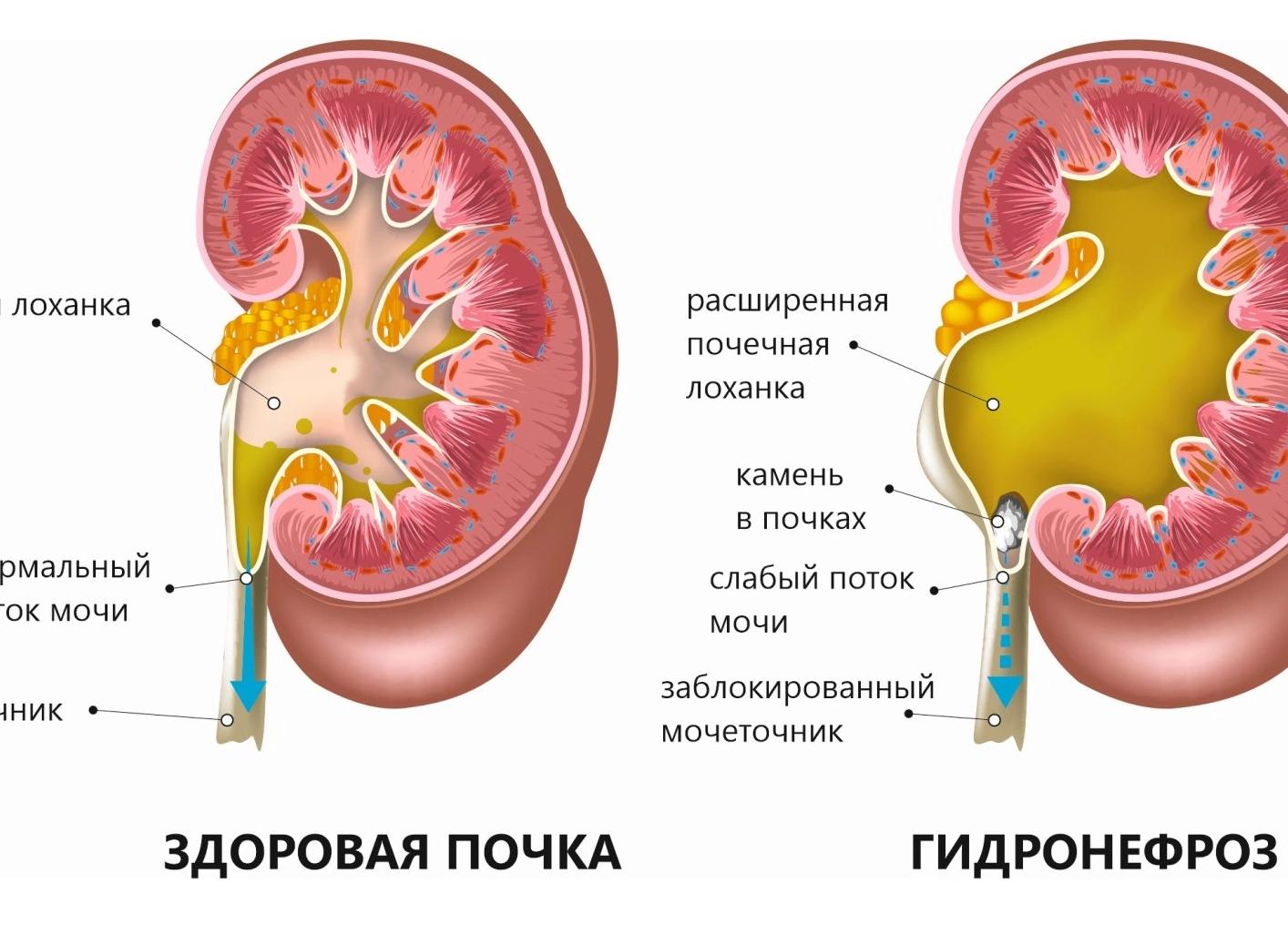 Чашечно лоханочная система норма
