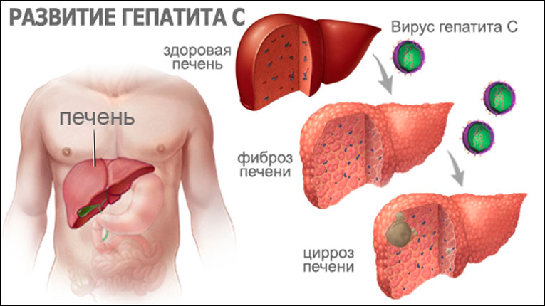 Гепатит что за болезнь