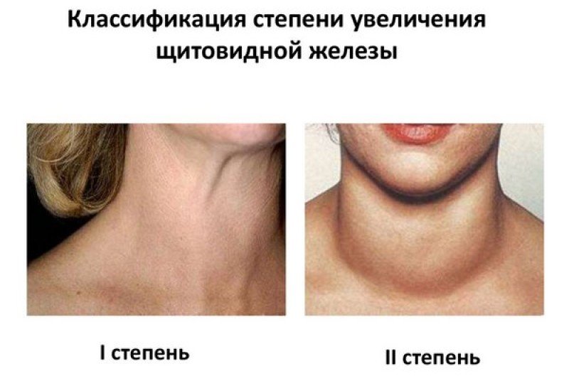 Как понять что увеличена щитовидная железа