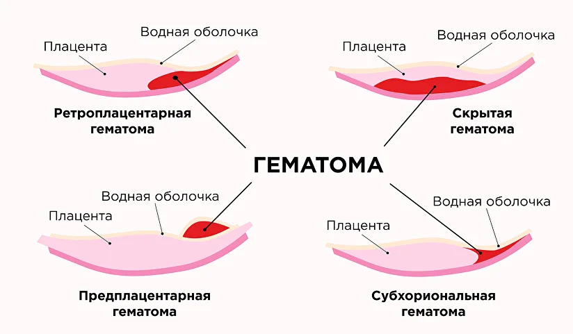 Кровянистые выделения в
