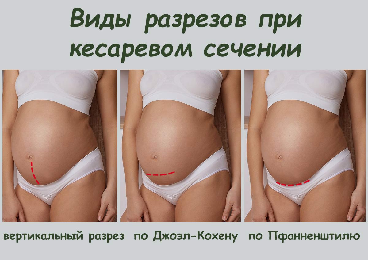 Матка после кесарева