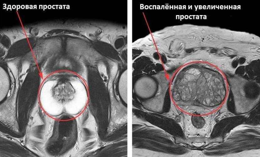 Мрт аденомы простаты