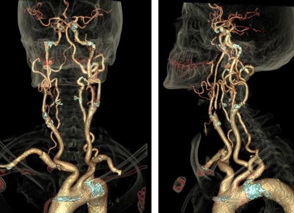 Мрт шейного отдела позвоночника и сосудов шеи что показывает