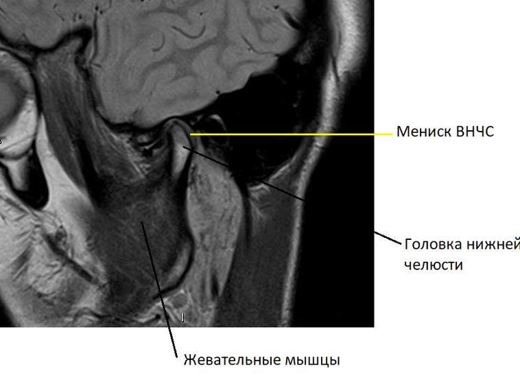 Мрт нижнечелюстного сустава