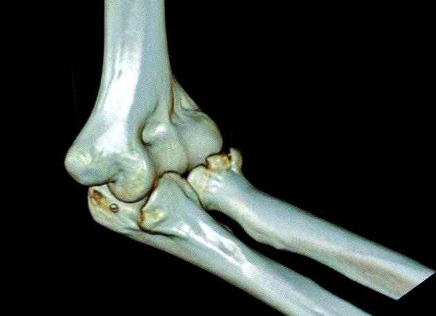 Мрт локтевого сустава что показывает