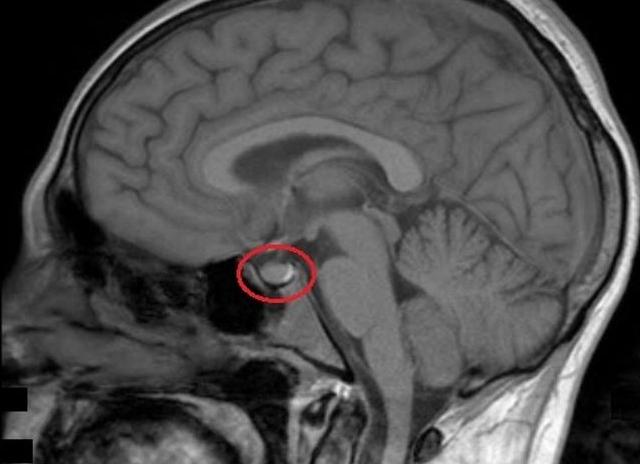 Мрт головного мозга гипофиз что показывает