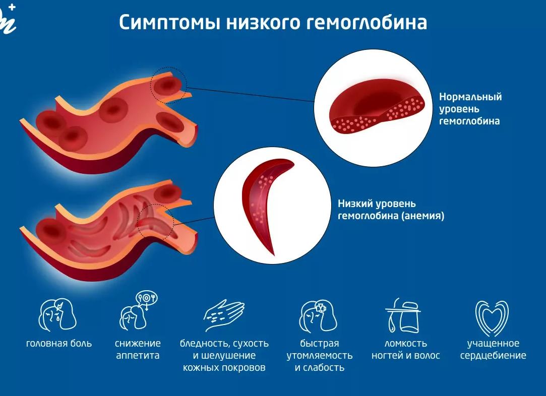 Может ли при низком гемоглобине болеть голова
