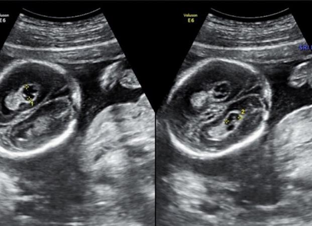 Киста сосудистого сплетения у плода Киста сосудистого сплетения у плода