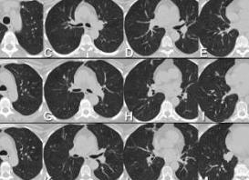 Как подготовиться к кт грудной клетки
