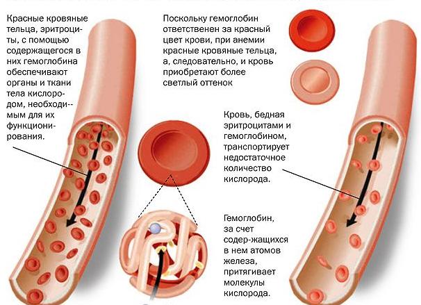 Хроническая железодефицитная анемия