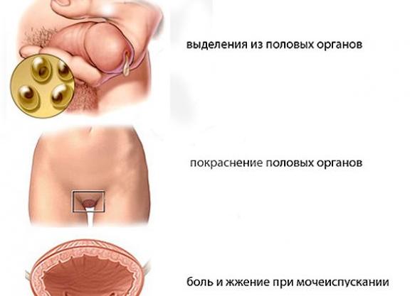 Хламидиоз что это такое и как передается