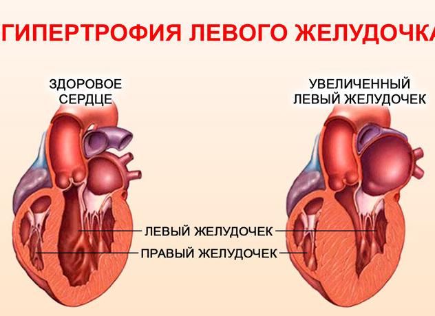 Гэф в левом желудочке