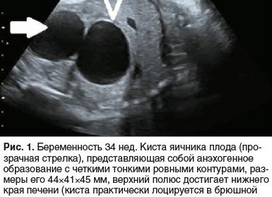 Фото узи киста яичника