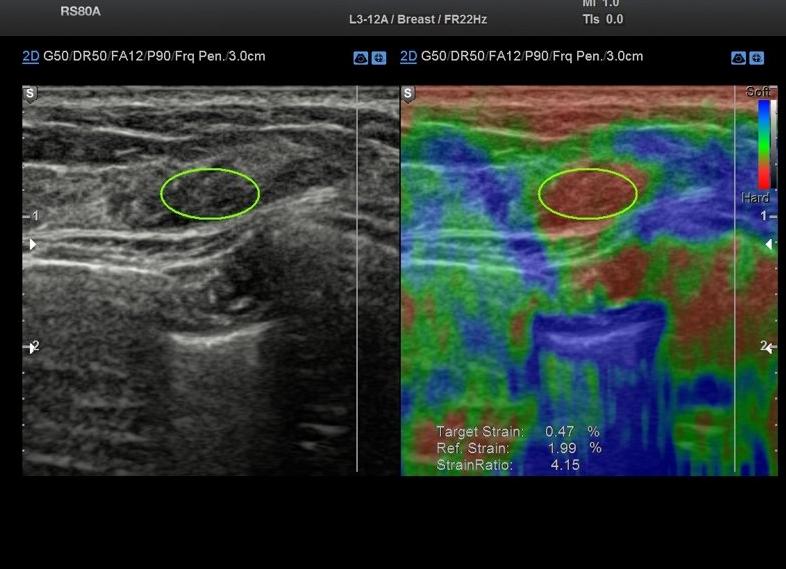 Эластография молочных желез