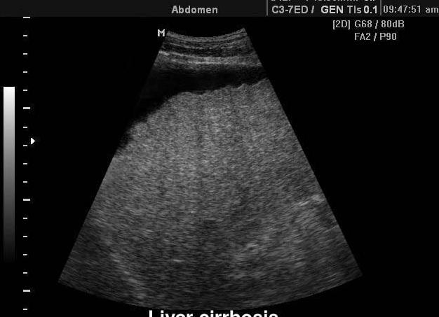 Цирроз печени на узи