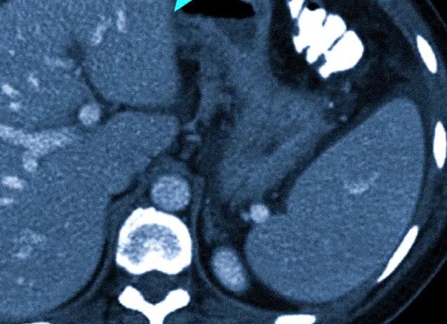 Что лучше мрт или гастроскопия желудка Что лучше мрт или гастроскопия желудка