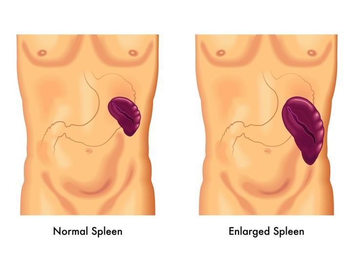 Что делать если увеличена селезенка