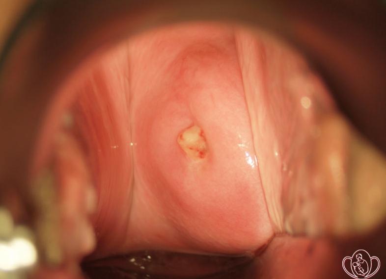 Белые выделения без зуда и жжения