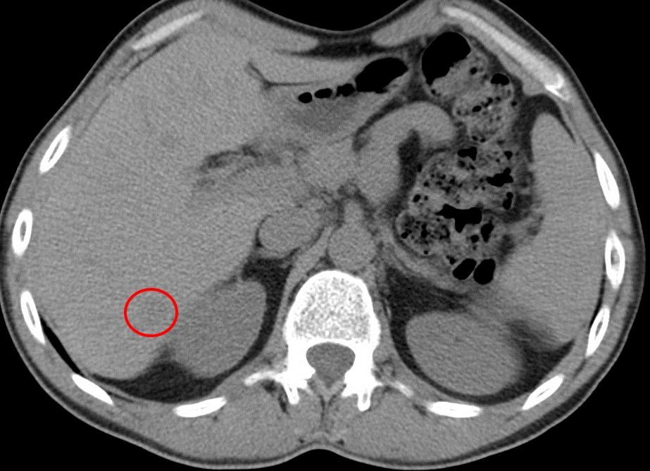 Атипичная гемангиома печени Атипичная гемангиома печени