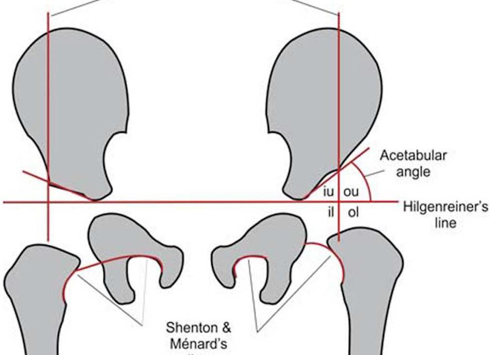 Ацетабулярный индекс норма