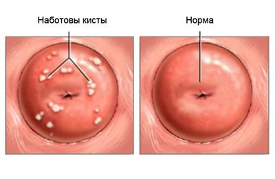 Киста наботовой железы