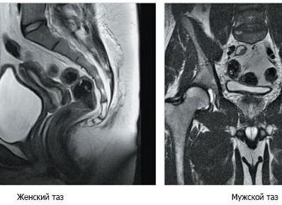 Мрт женских органов малого таза