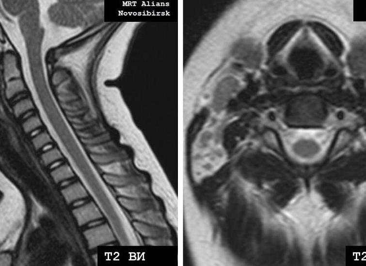 Мрт шейного отдела позвоночника