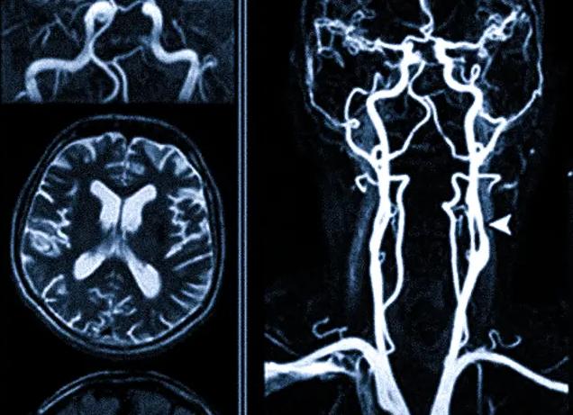 Мрт артерий шеи что показывает Мрт артерий шеи что показывает