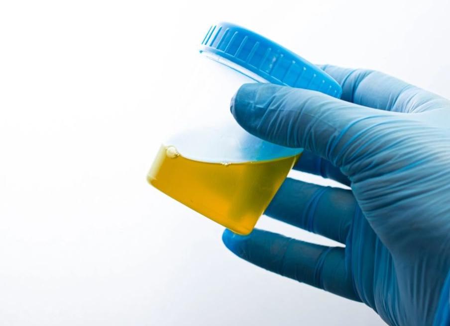 Мочевина в моче Мочевина в моче