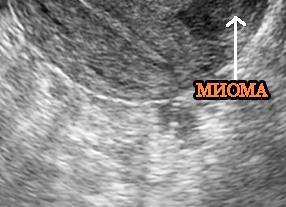 Миома на узи