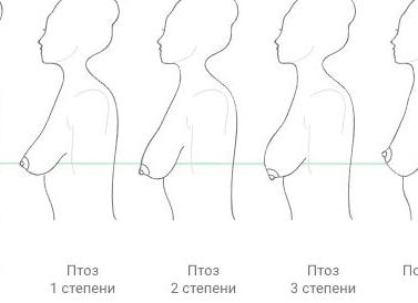 Инволюция молочных желез что это