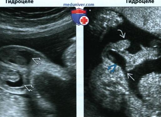 Гидроцеле у плода на узи