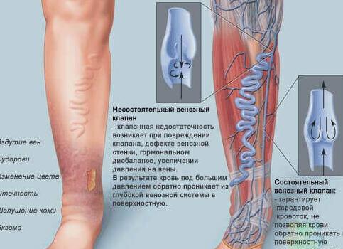 Диагностика сосудов нижних конечностей