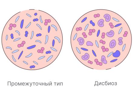 Что такое выраженный дисбиоз