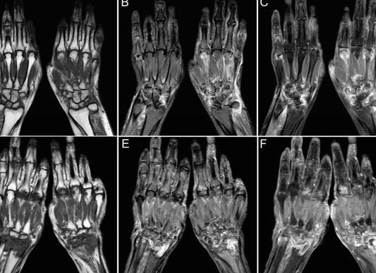 Что покажет мрт руки