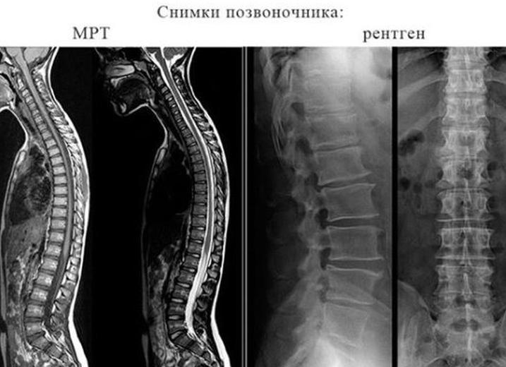 Что лучше мрт или рентген поясничного отдела
