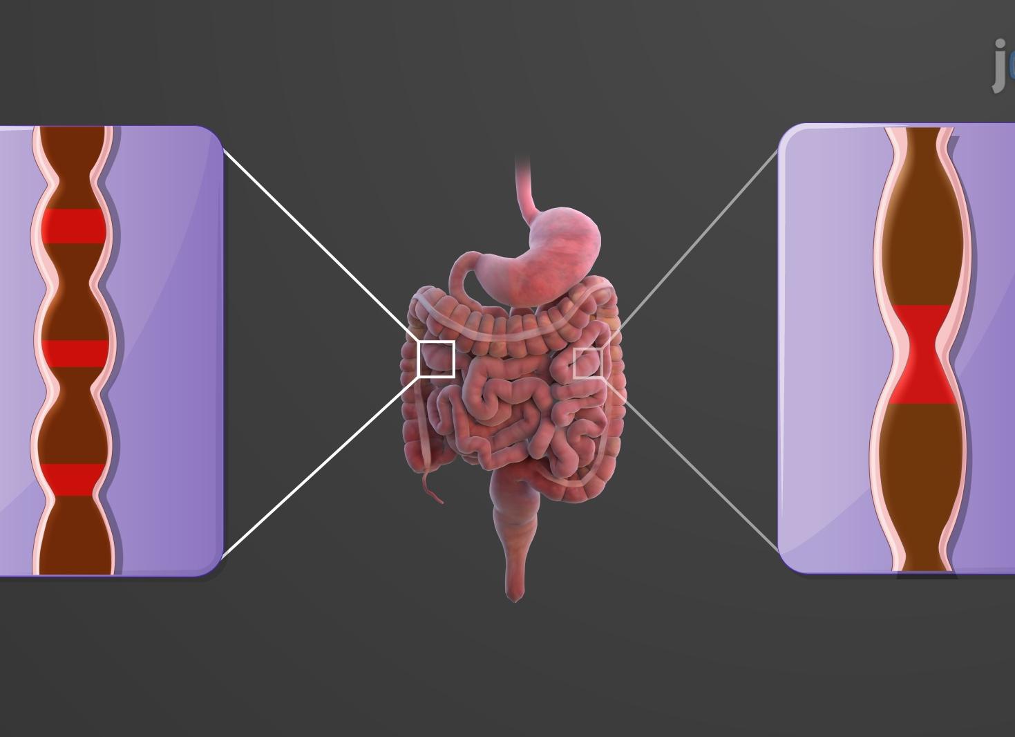 Белок в кале у взрослого что это значит