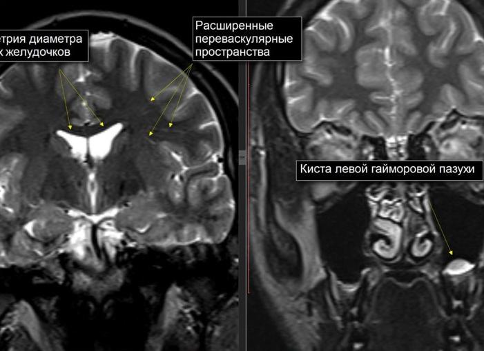 Ассиметричные боковые желудочки головного мозга у грудничка