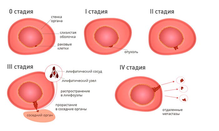 Как называются раковые клетки