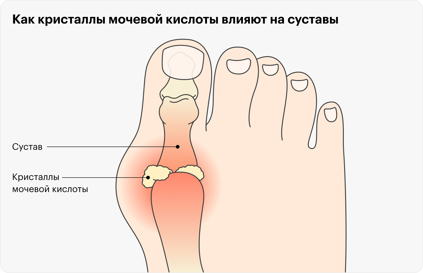Мочевая кислота на что влияет