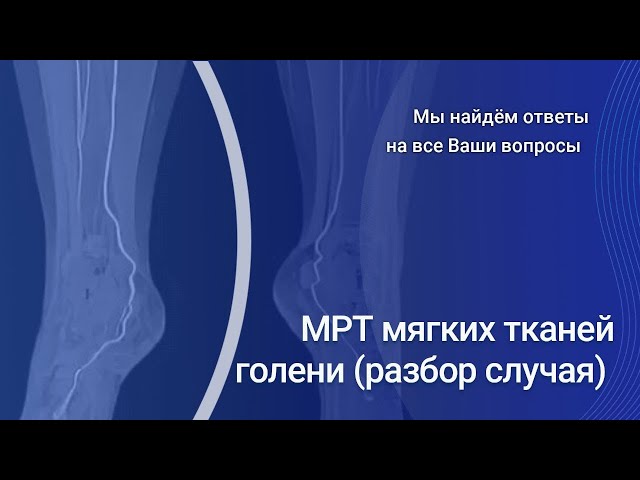 Мрт мягких тканей голени