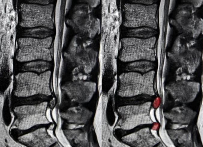 Мрт позвоночника грыжа