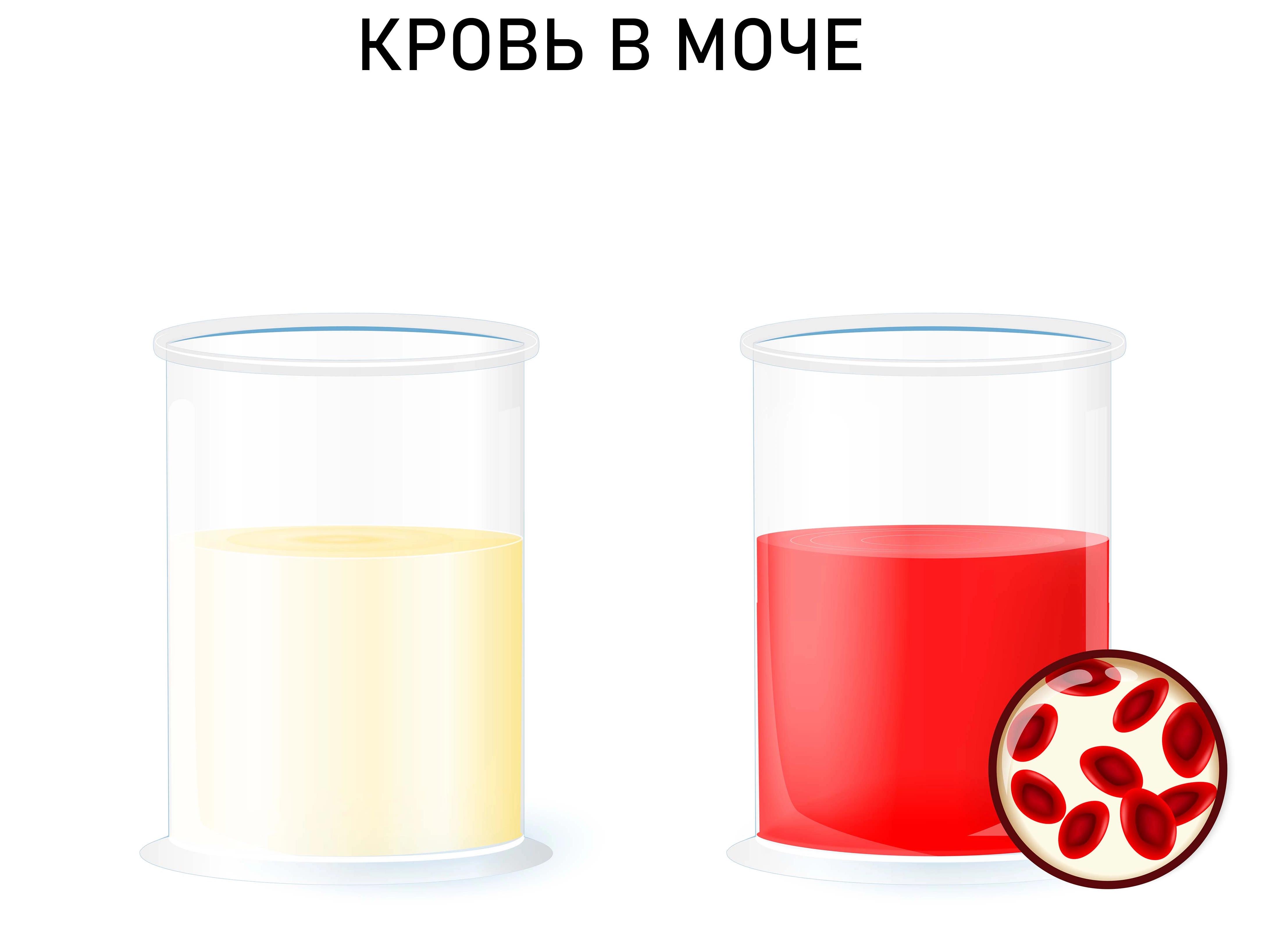 Моча у мужчины с кровью Моча у мужчины с кровью