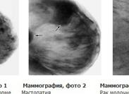 Маммограмма молочных желез