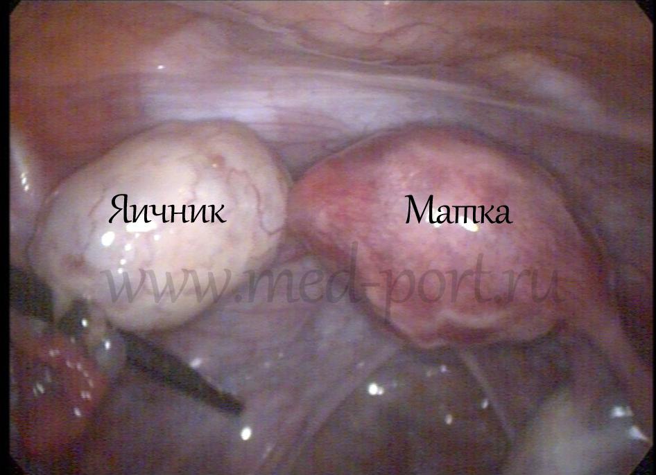 Левый яичник увеличен