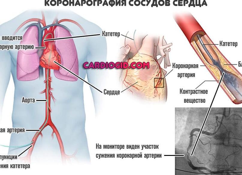 Коронарография сосудов сердца что это последствия
