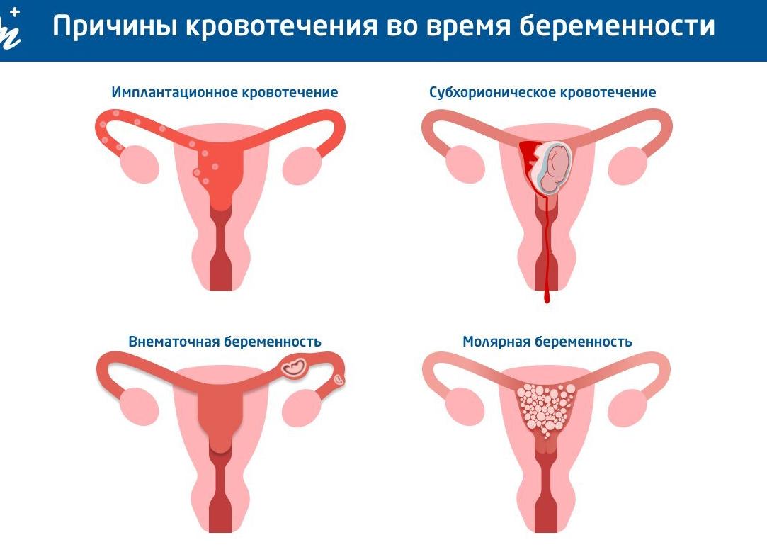 Коричневые выделения с кислым запахом