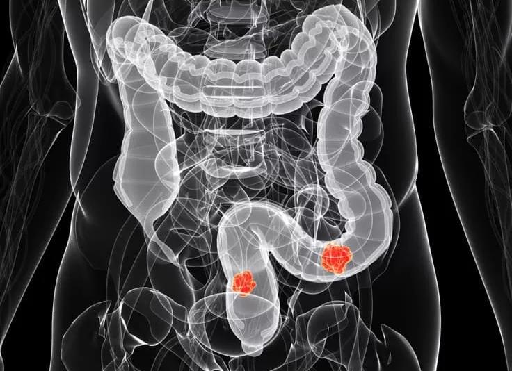 Колоноскопия или ирригоскопия Колоноскопия или ирригоскопия