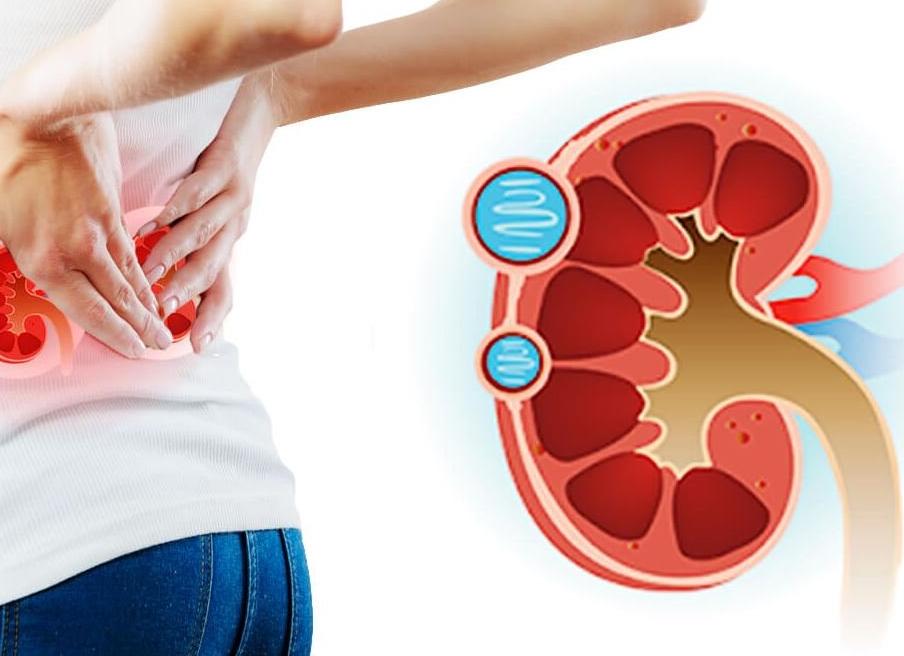 Кисты почек что это такое исход заболевания